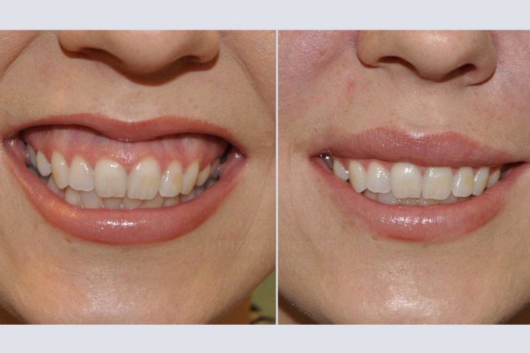 Gum Contouring  Dr Akshay Sharma – Dr Akshay Sharma